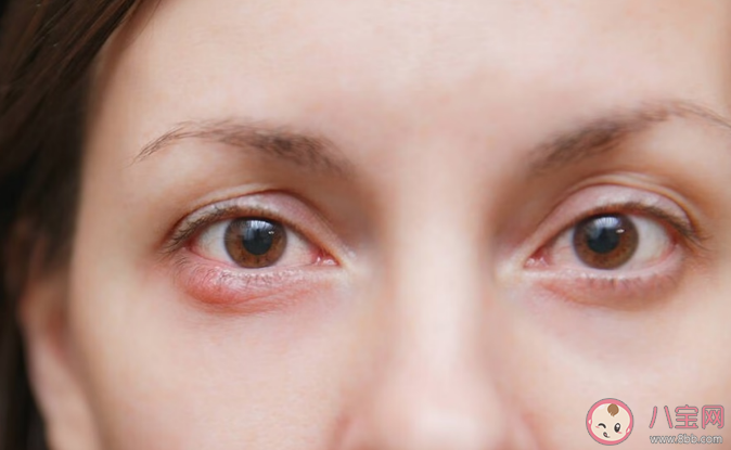 為什么電腦和手機看久了會得斜視 哪些表現可能是真斜視