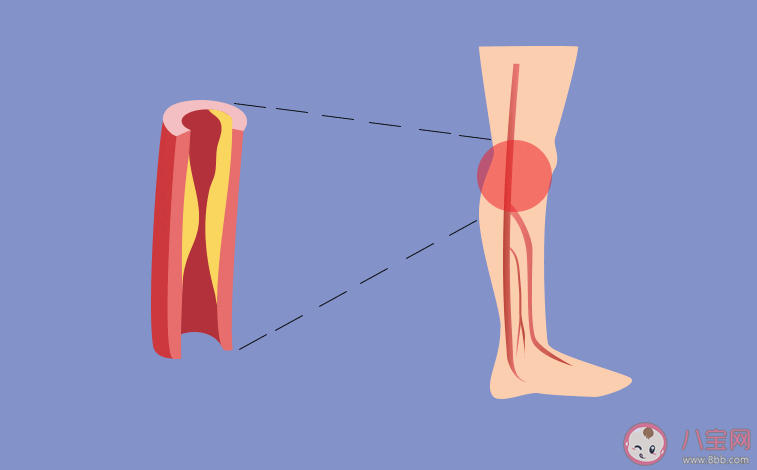 補鈣后還是腿抽筋要怎么辦 腿抽筋要怎么辦