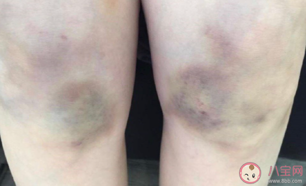 為什么你身上總有淤青 淤青應(yīng)該怎么消除