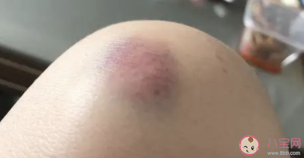 為什么你身上總有淤青 淤青應(yīng)該怎么消除