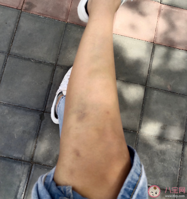 為什么你身上總有淤青 淤青應(yīng)該怎么消除