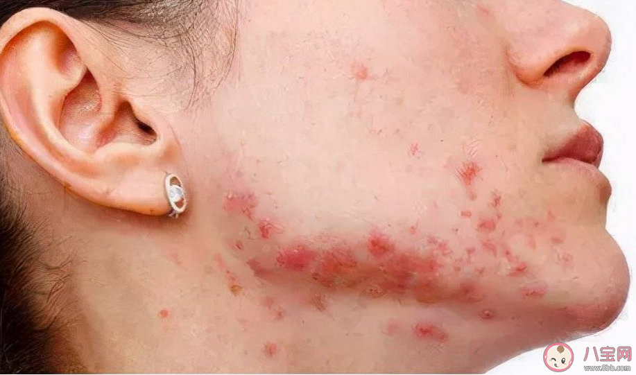 為什么來大姨媽會長痘 姨媽痘喜歡長在哪里 為什么來大姨媽會長痘 姨媽痘喜歡長在哪里