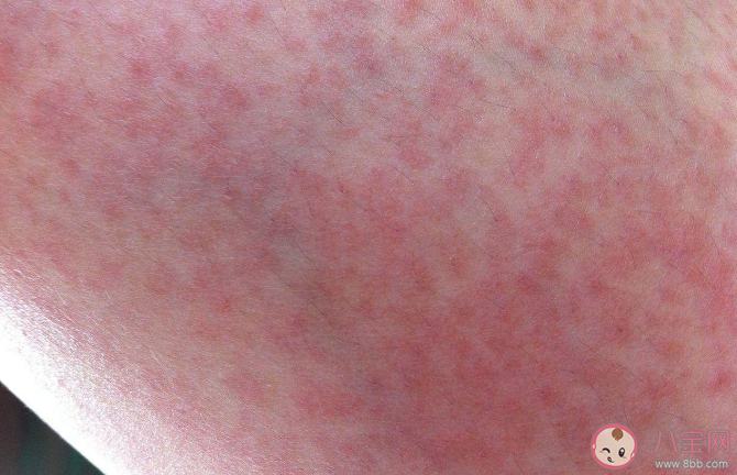 運動性過敏是怎么來的 運動性過敏有什么癥狀