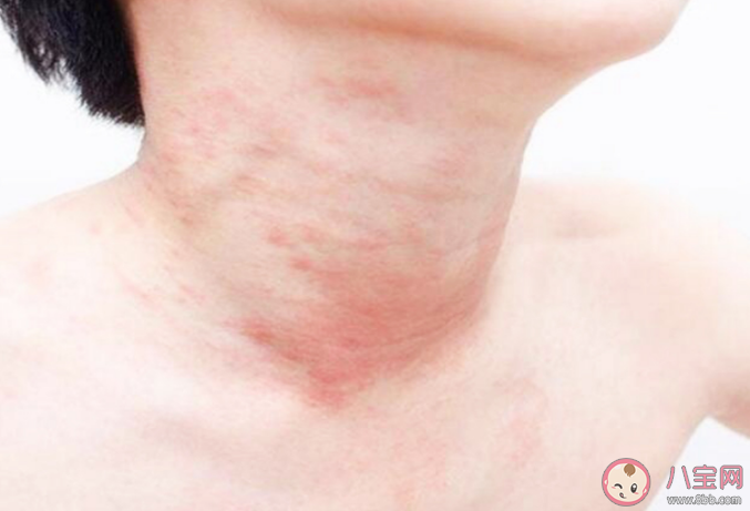 運動性過敏是怎么來的 運動性過敏有什么癥狀