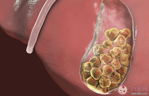 膽結石會不會變成癌 預防膽結石要多留意這4個方面 膽結石會不會變成癌 預防膽結石要多留意這4個方面