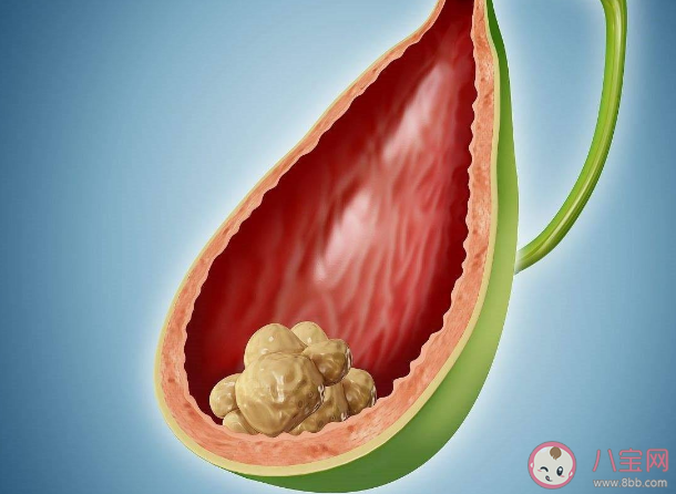 膽結石會不會變成癌 預防膽結石要多留意這4個方面 膽結石會不會變成癌 預防膽結石要多留意這4個方面