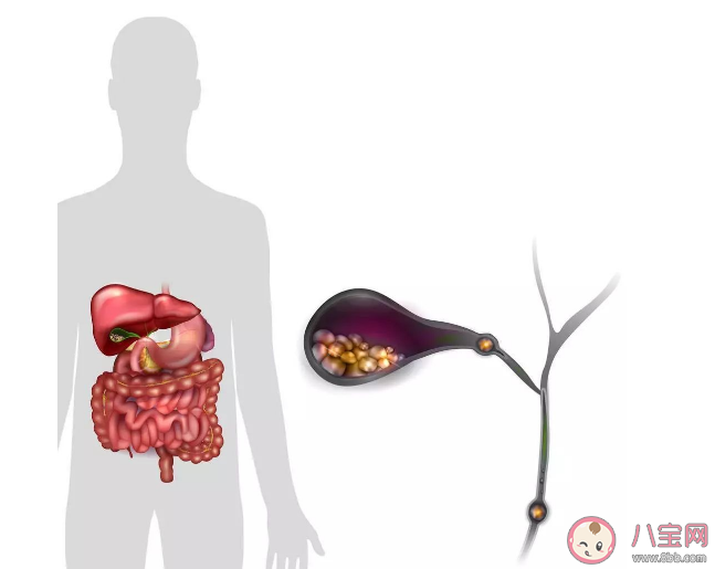 膽結石會不會變成癌 預防膽結石要多留意這4個方面 膽結石會不會變成癌 預防膽結石要多留意這4個方面