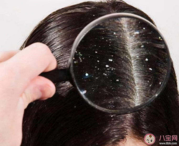 入秋之后為何頭皮屑變多 頭皮屑嚴重是什么原因