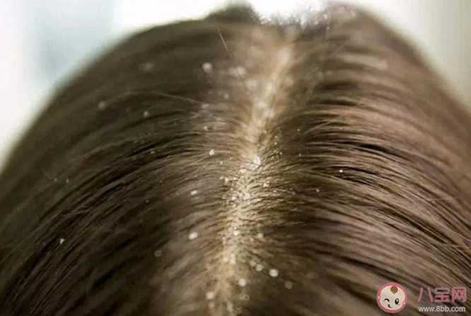 入秋之后為何頭皮屑變多 頭皮屑嚴重是什么原因