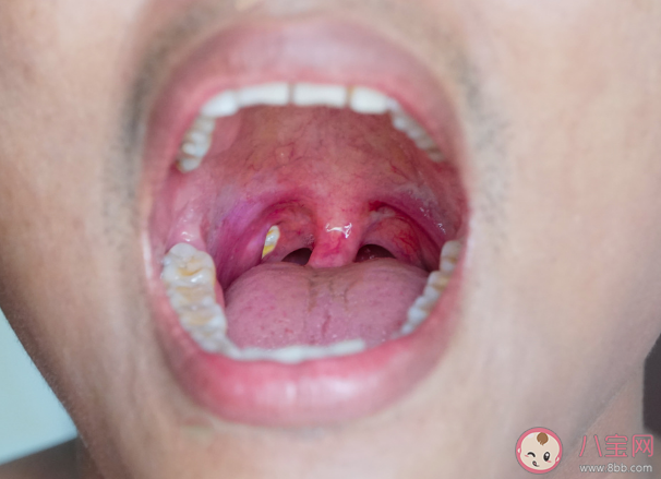 扁桃體也會長結(jié)石嗎 如何預(yù)防扁桃體結(jié)石復(fù)發(fā) 扁桃體也會長結(jié)石嗎 如何預(yù)防扁桃體結(jié)石復(fù)發(fā)