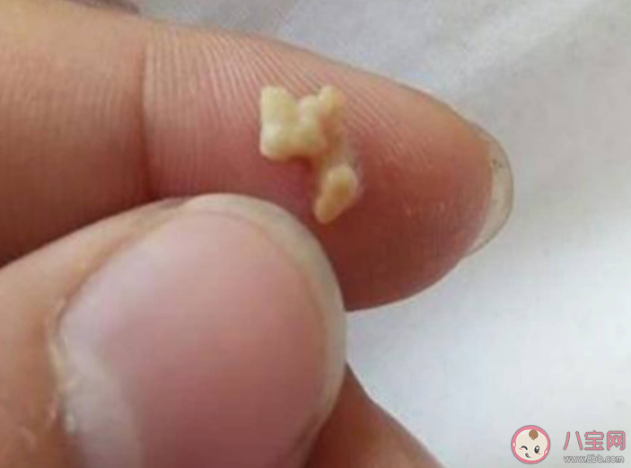 扁桃體也會長結(jié)石嗎 如何預(yù)防扁桃體結(jié)石復(fù)發(fā) 扁桃體也會長結(jié)石嗎 如何預(yù)防扁桃體結(jié)石復(fù)發(fā)