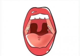 扁桃體也會(huì)長(zhǎng)結(jié)石嗎 如何預(yù)防扁桃體結(jié)石復(fù)發(fā)