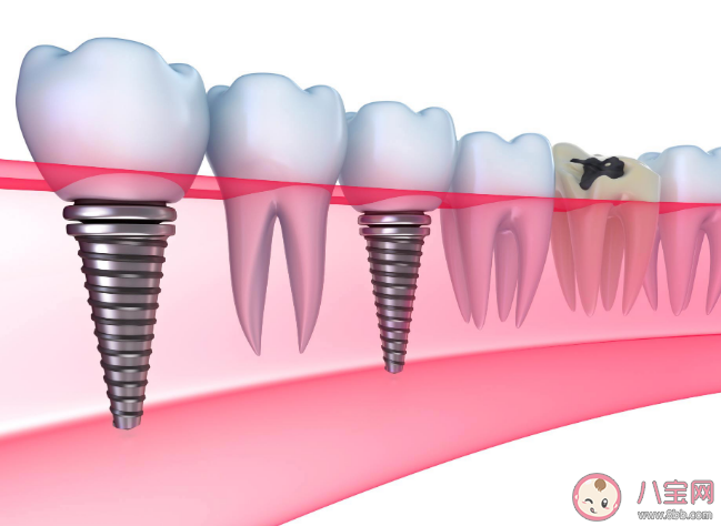 種植牙會(huì)干擾影像檢查嗎 種植牙松動(dòng)了怎么辦