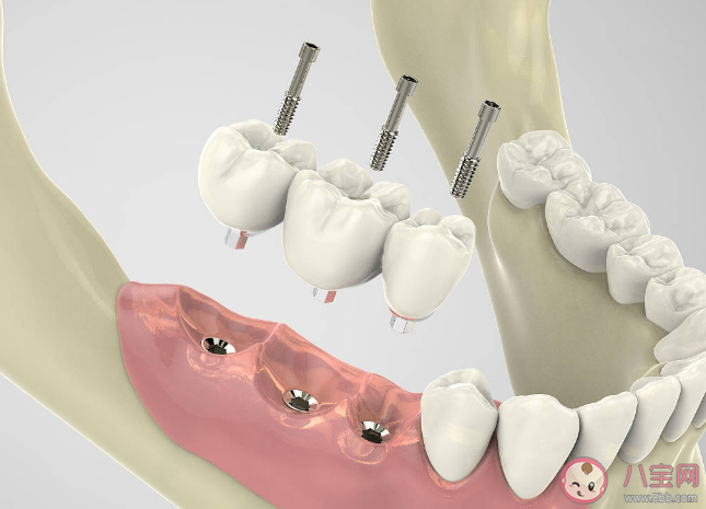 種植牙會(huì)干擾影像檢查嗎 種植牙松動(dòng)了怎么辦
