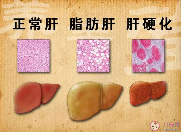 女子節(jié)食減肥減出脂肪肝是怎么回事 脂肪肝是如何產(chǎn)生的 女子節(jié)食減肥減出脂肪肝是怎么回事 脂肪肝是如何產(chǎn)生的