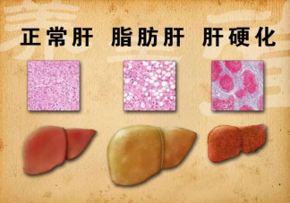 女子節食減肥減出脂肪肝是怎么回事 脂肪肝是如何產生的