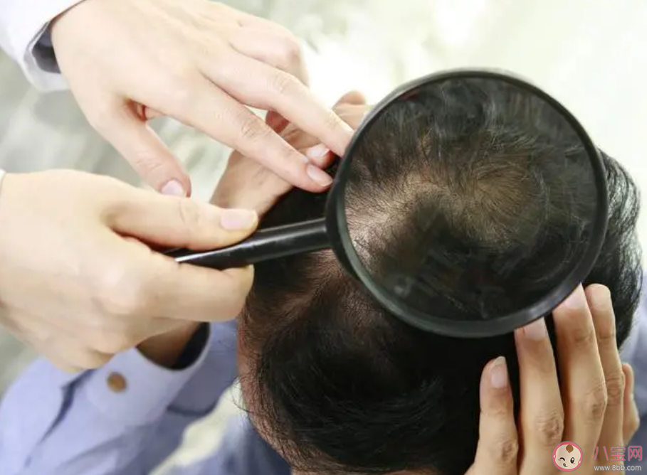 每天掉多少根頭發(fā)才算脫發(fā) 脫發(fā)該怎么辦