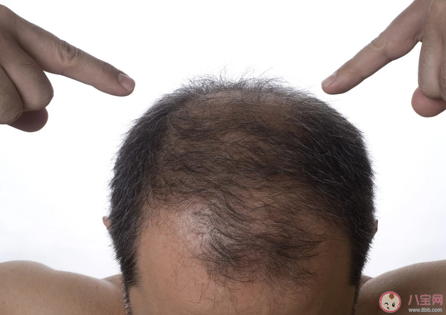 每天掉多少根頭發(fā)才算脫發(fā) 脫發(fā)該怎么辦