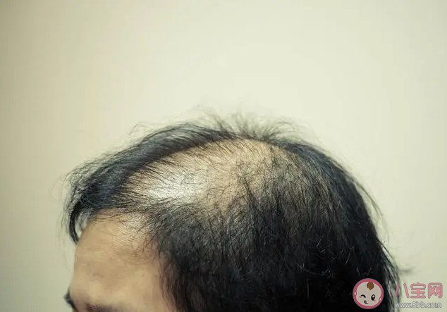 每天掉多少根頭發(fā)才算脫發(fā) 脫發(fā)該怎么辦