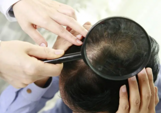 每天掉多少根頭發(fā)才算脫發(fā) 脫發(fā)該怎么辦