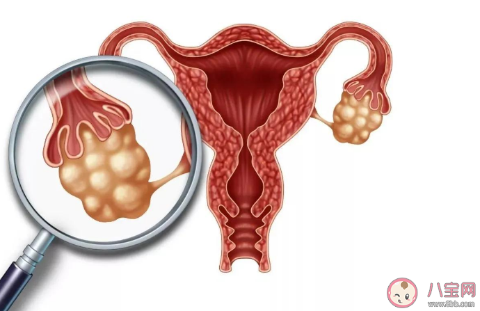 常喝咖啡會導致卵巢囊腫嗎 患有卵巢囊腫會有感覺嗎