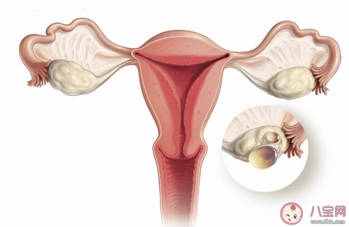 常喝咖啡會導致卵巢囊腫嗎 患有卵巢囊腫會有感覺嗎
