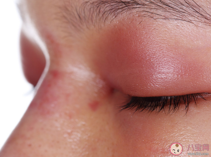 不同部位上火臉上有什么表現 怎樣去火效果好