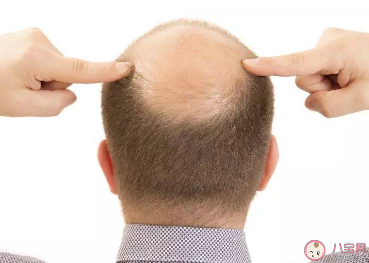 掉頭發(fā)可能是缺哪幾種營養(yǎng)素 一直掉頭發(fā)該怎么辦