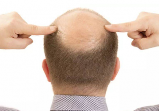 掉頭發可能是缺哪幾種營養素 一直掉頭發該怎么辦