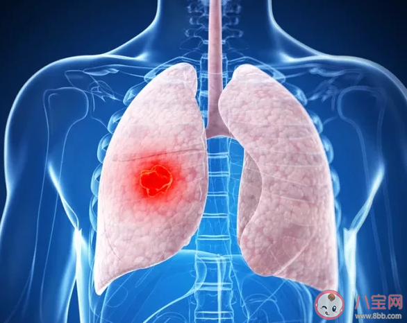 29歲姑娘無癥狀確診肺癌是怎么回事 導致肺癌的原因有哪些