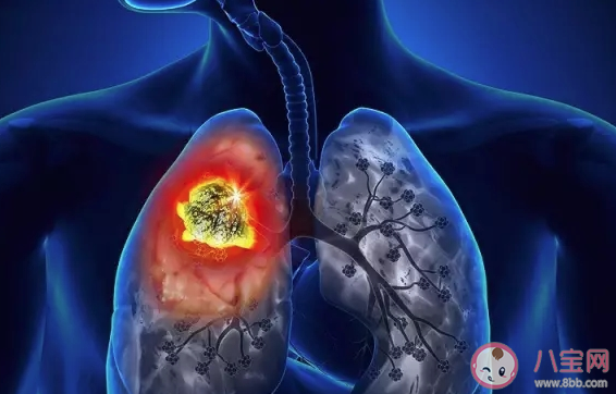 29歲姑娘無癥狀確診肺癌是怎么回事 導致肺癌的原因有哪些