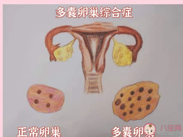 有多囊卵巢綜合征女性會出現爆痘 多囊卵巢綜合征會有哪些癥狀