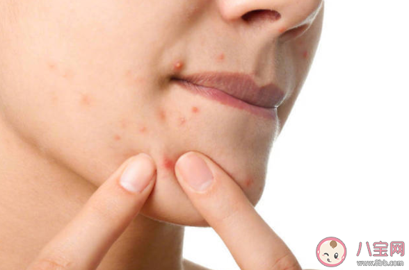 有多囊卵巢綜合征女性會出現爆痘 多囊卵巢綜合征會有哪些癥狀