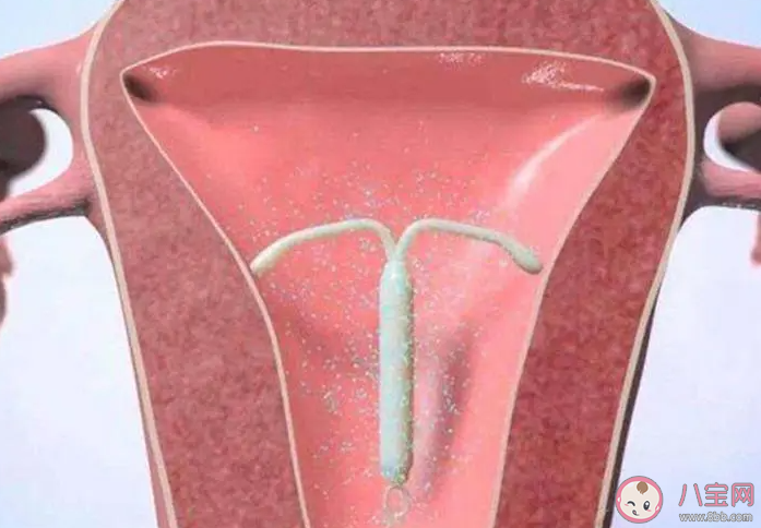 節育環真的是讓子宮不斷發炎來避孕嗎 節育環過了保質期一定要取出嗎 節育環真的是讓子宮不斷發炎來避孕嗎 節育環過了保質期一定要取出嗎