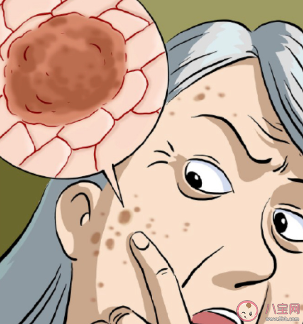 00后長期熬夜長出老年斑是怎么回事 年輕人為什么會長老年斑