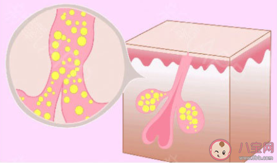 頭皮上摳出來的小顆粒到底是啥 經常摳頭皮顆粒會禿頂嗎